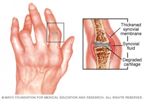 r7_rheumatoidarthritis